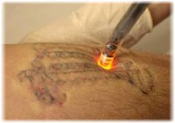 laser tattoo