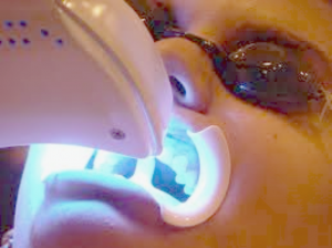 laser teeth